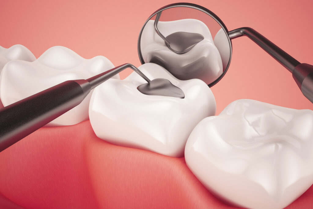 materiales de restauración y prevención dental