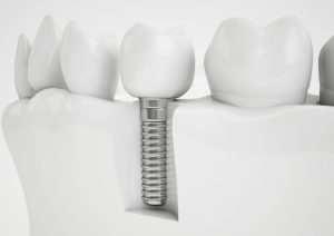 A model demonstrating how dental implants are secured