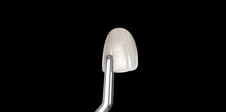 Procedimiento-instalación-carilla-incisivo-central-Ilustración-3D-diente-médicamente.alt-precisa-768x382