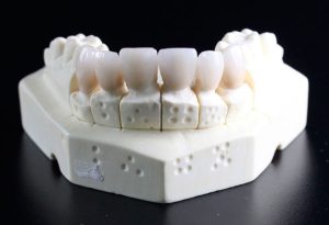 biomateriales-dentales-reemlplazo-de-dientes-768x524