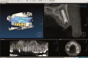 cad-cam-dental-radiografia-dental-3d-digital