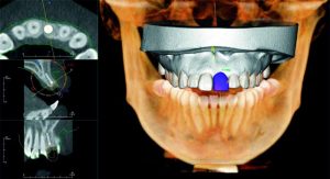 cad-cam-dental-radriografia-digital-dental-protesis