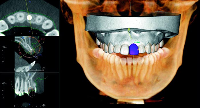 cad-cam-dental-radriografia-digital-dental-protesis