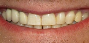 hipoplasia-del-esmalte-dental.alt_-768x371