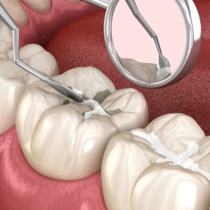 Molar tooth fissure restoration with filling. Medically accurate tooth 3D illustration.