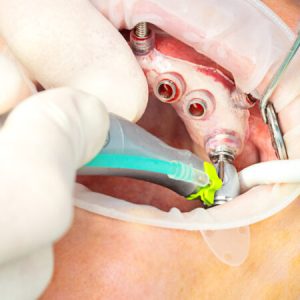 Close up of digital guided implant surgery on patient - new implant technology in dentistry.