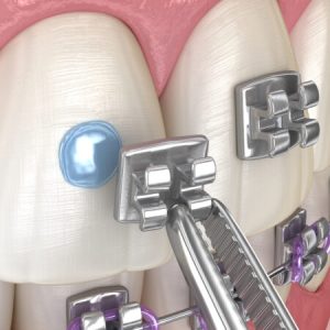 Metal braces installation process. Medically accurate dental 3D illustration
