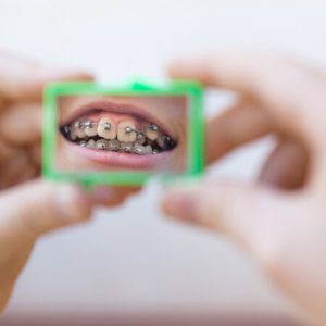 Hands holding a small mirror that reflects the mouth of a smiling girl with orthodontics