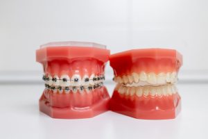mouth guard and models of teeth with braces on teeth on a jaw