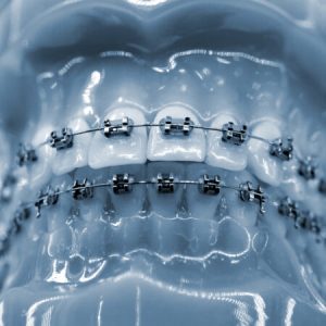 Braces on a model of human teeth, dental tooth dentistry close-up.