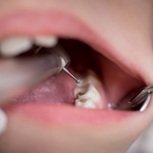 Open mouth during drilling treatment at the dentist in dental clinic. Close-up. Dentistry