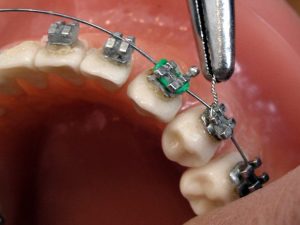 tratamientos-corregir-la-oclusión-dental-brackets.alt_