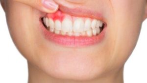 ¿Qué-beneficios-tiene-hacerse-un-tratamiento-periodontal-727x409-1-450x253