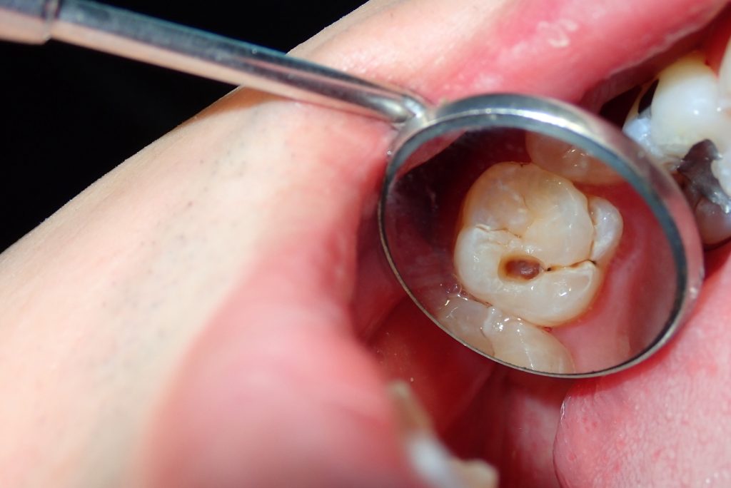 caries después de la ortodoncia